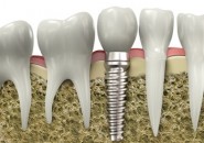 L’implantologia dentale a carico immediato