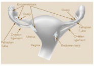 Endometriosi, la più temuta malattia dell’utero