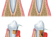 Piorrea o parodontite, la malattia delle gengive